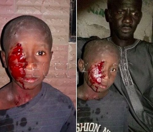 Rufisque : Petit Aliou battu par son oncle à l’aide d’un pilon…