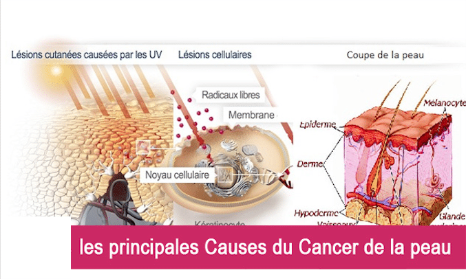 Santé : Voici les principales Causes du Cancer de la peau et comment les prévenir Découvrez !