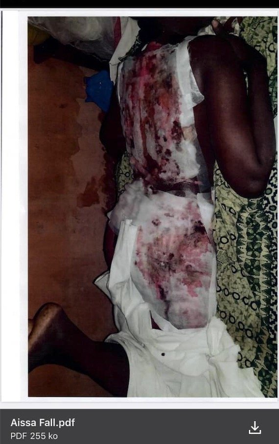 [SOS] Aïssa Fall, victime de brûlure : « Mon cœur peut lâcher à tout moment »