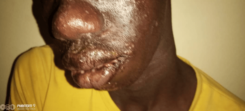 (Photos) Une étrange maladie touche des pêcheurs sénégalais, Thiaroye Sur-Mer troublée