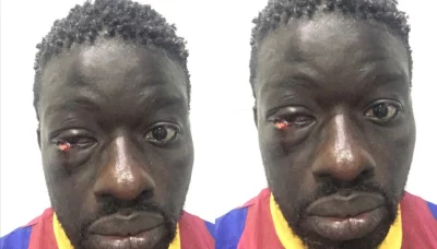 La terrible blessure à l’oeil de Zoss face à Alioune Seye 2, âme sensibles s’abstenir