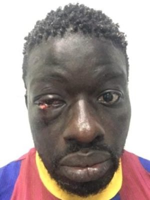 La terrible blessure à l’oeil de Zoss face à Alioune Seye 2, âme sensibles s’abstenir (Photo)