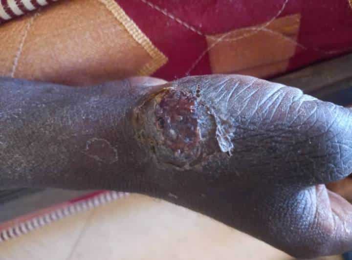 Maroc : Cri de détresse de migrants Sénégalais bloqués, les infections cutanées font rage (Photos + vidéos)