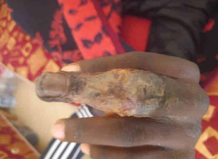 Maroc : Cri de détresse de migrants Sénégalais bloqués, les infections cutanées font rage (Photos + vidéos)