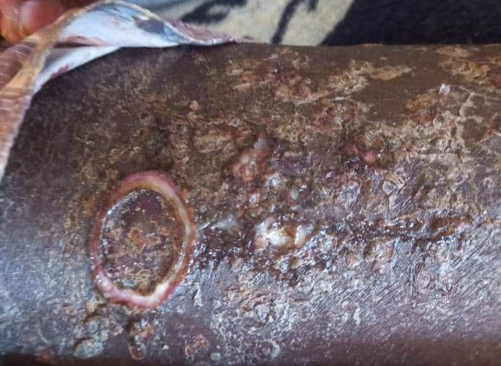 Maroc : Cri de détresse de migrants Sénégalais bloqués, les infections cutanées font rage (Photos + vidéos)