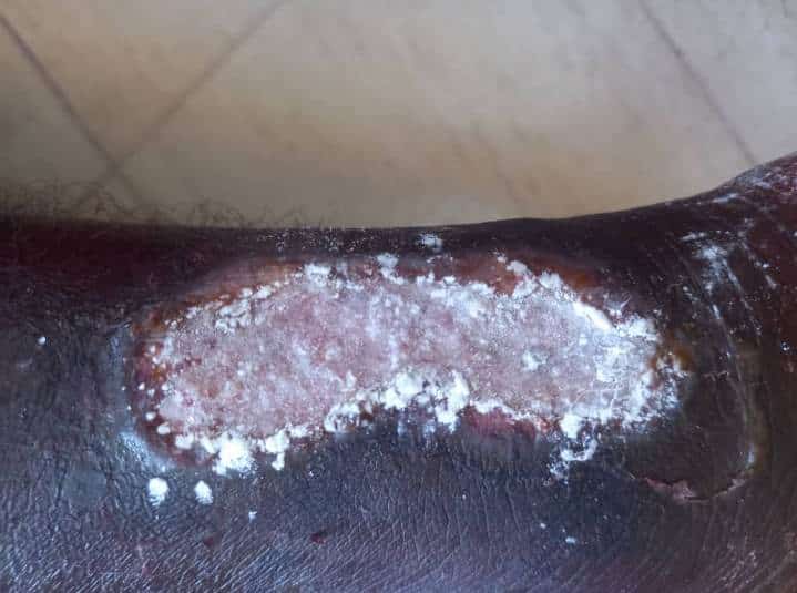 Maroc : Cri de détresse de migrants Sénégalais bloqués, les infections cutanées font rage (Photos + vidéos)