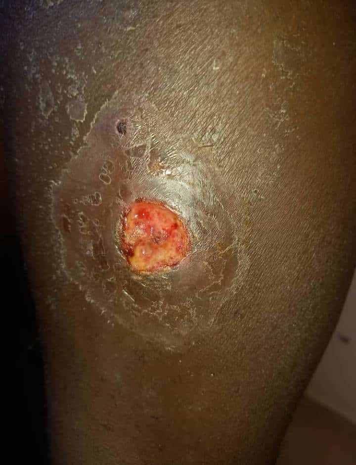 Maroc : Cri de détresse de migrants Sénégalais bloqués, les infections cutanées font rage (Photos + vidéos)