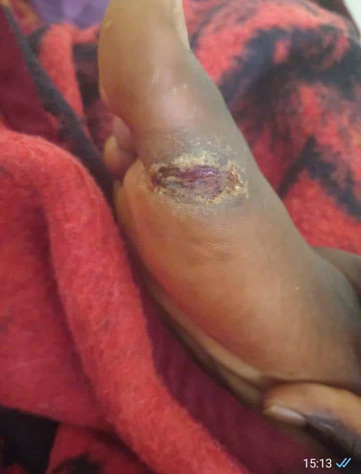 Maroc : Cri de détresse de migrants Sénégalais bloqués, les infections cutanées font rage (Photos + vidéos)