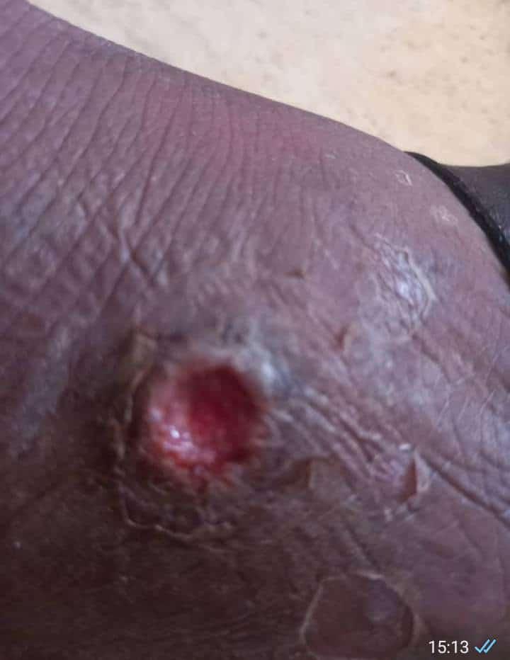 Maroc : Cri de détresse de migrants Sénégalais bloqués, les infections cutanées font rage (Photos + vidéos)